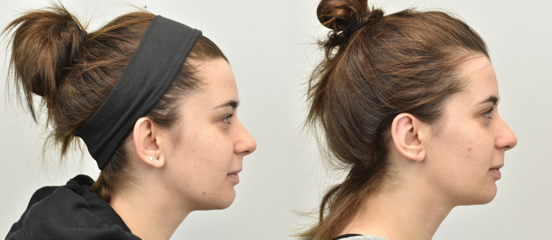 a before and after photo of a woman's face after otoplasty procedure
