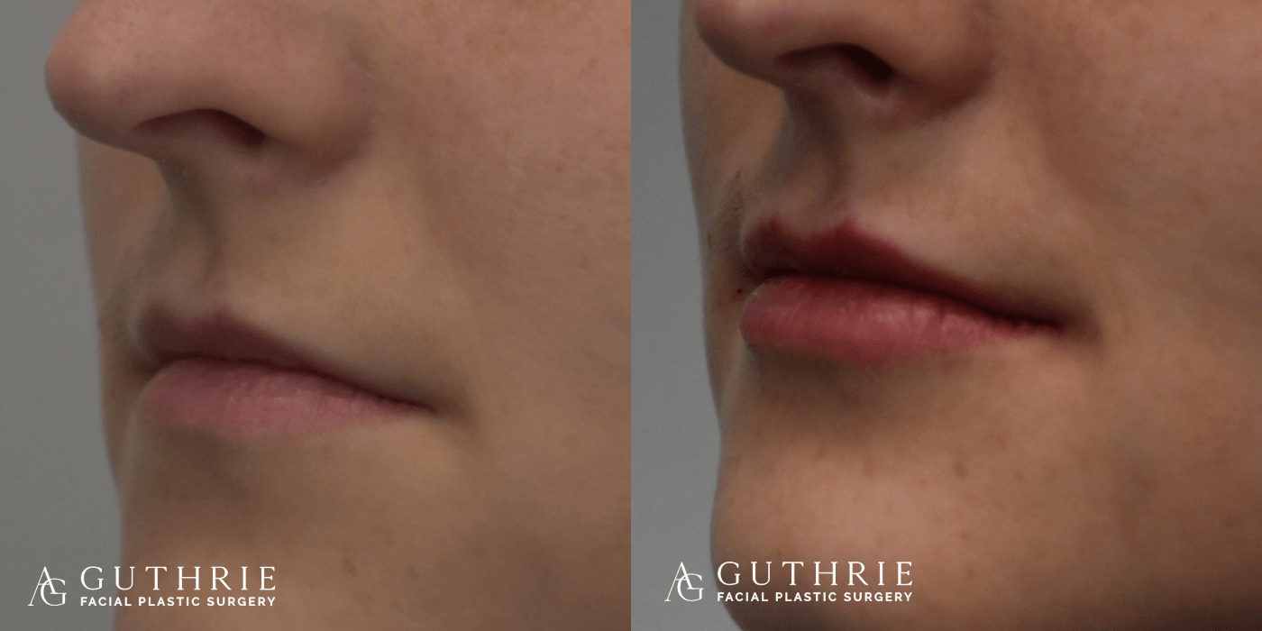 Before and After Lip Fillers