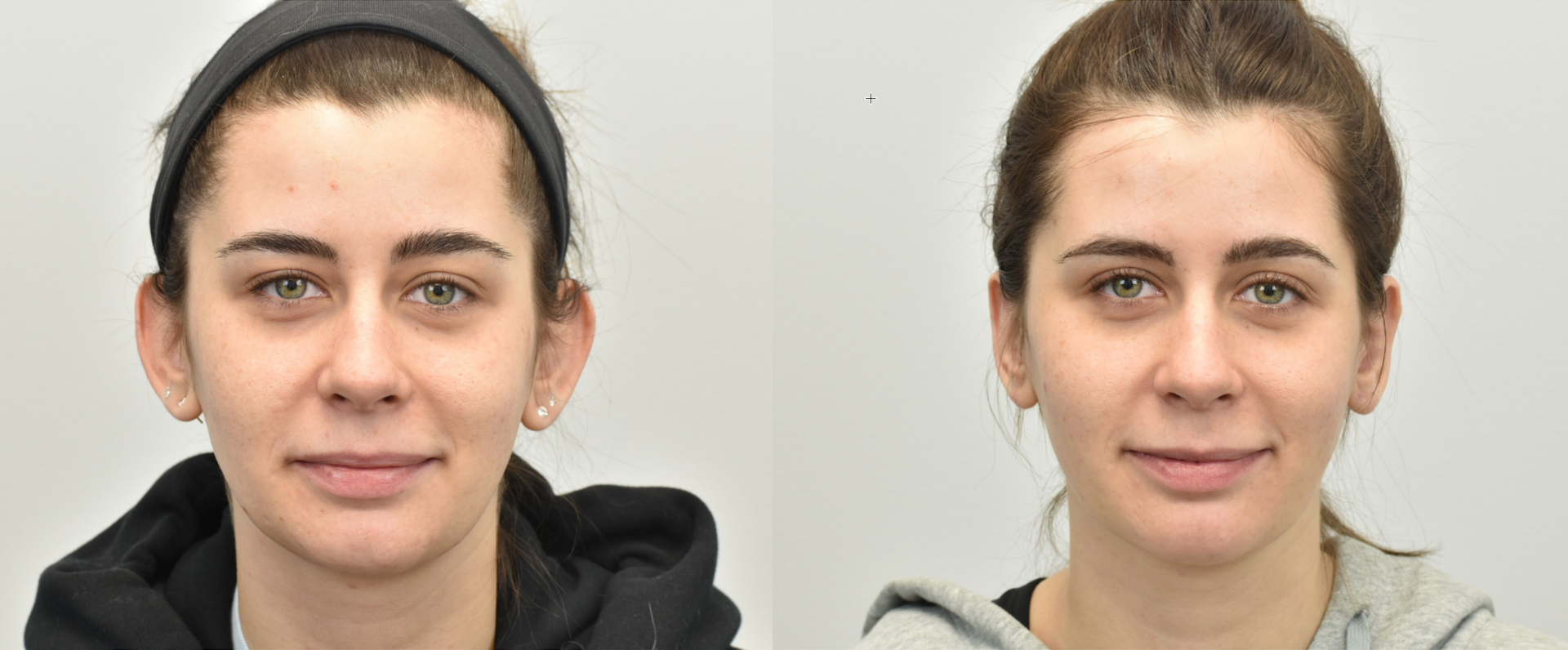 Before and After Otoplasty