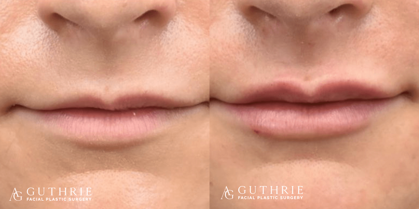 Before and After Lip Fillers