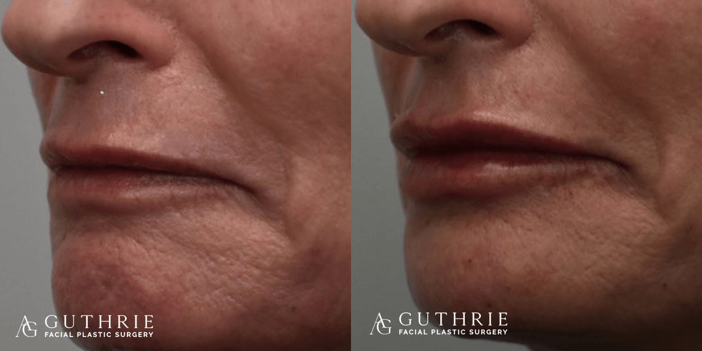 Before and After Lip Fillers