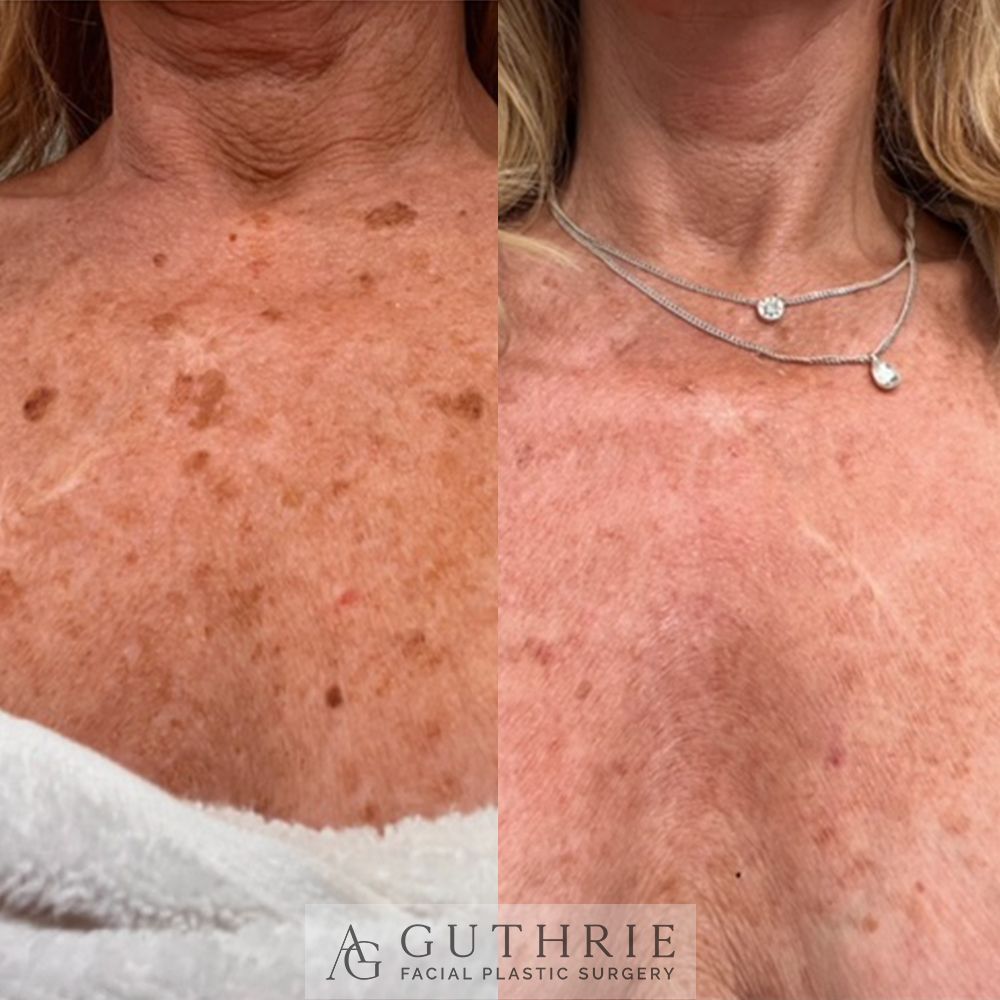 Before and After Tetra CO2 Laser Resurfacing Treatment on Chest