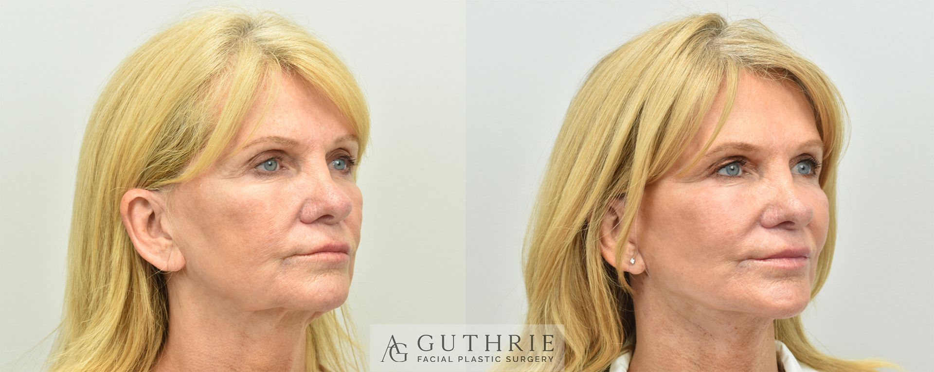 Before and After Deep Plane Facelift and Necklift