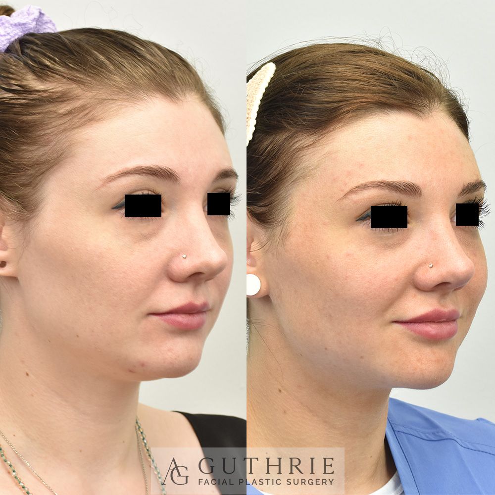 Before and After Submental Liposuction and Buccal Fat Reduction
