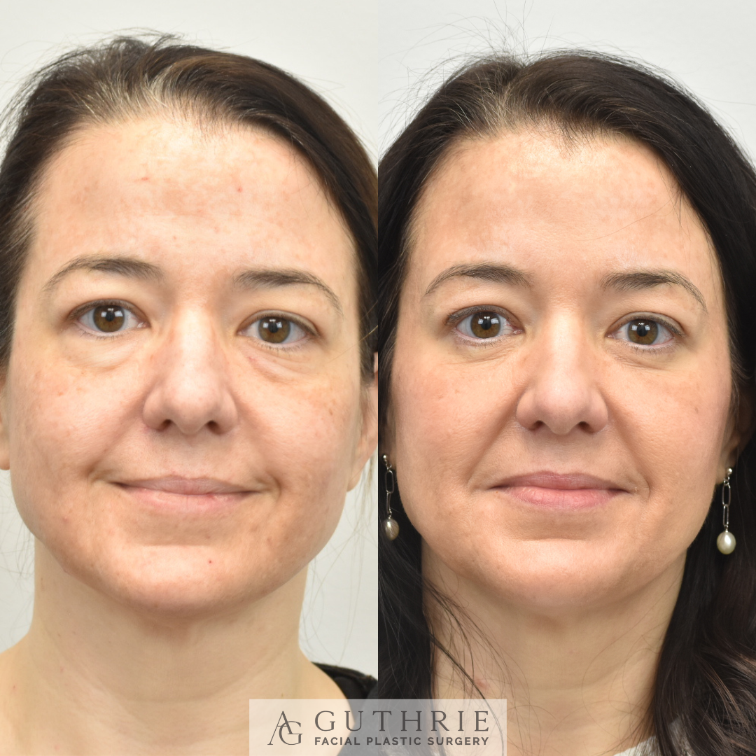 Before and After Lower Blepharoplasty and Endoscopic Brow Lift