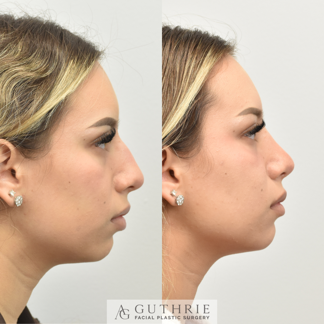 patient at guthrie facial plastic surgery in brentwood, tn before and after rhinoplasty surgery