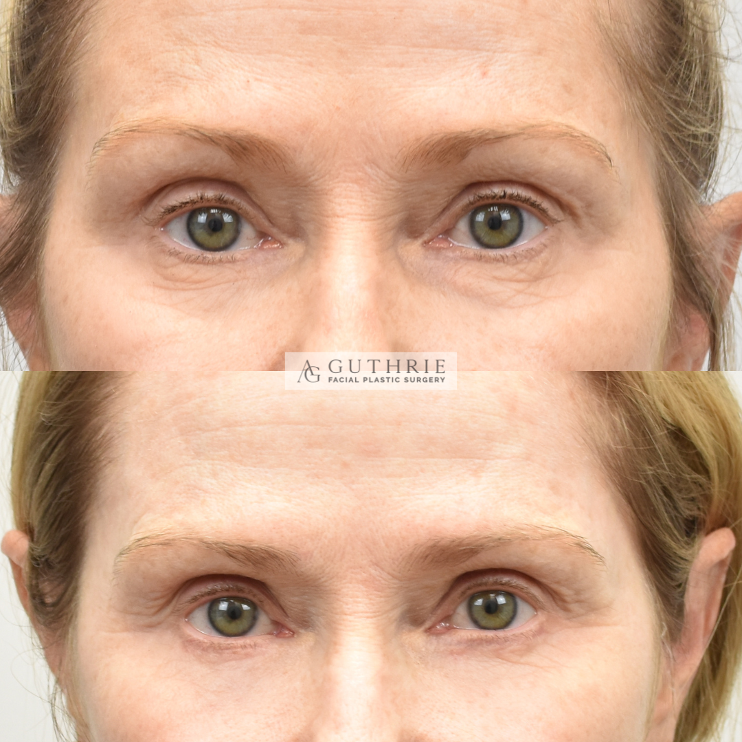 Before and After Lower Blepharoplasty with Fat Transfer