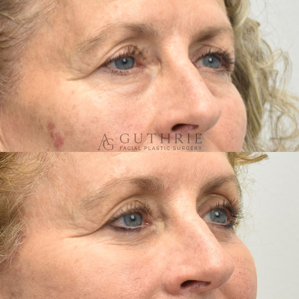 Before and After Lower Blepharoplasty, Deep Plane Facelift, Lateral Brow Lift, and CO2 Laser
