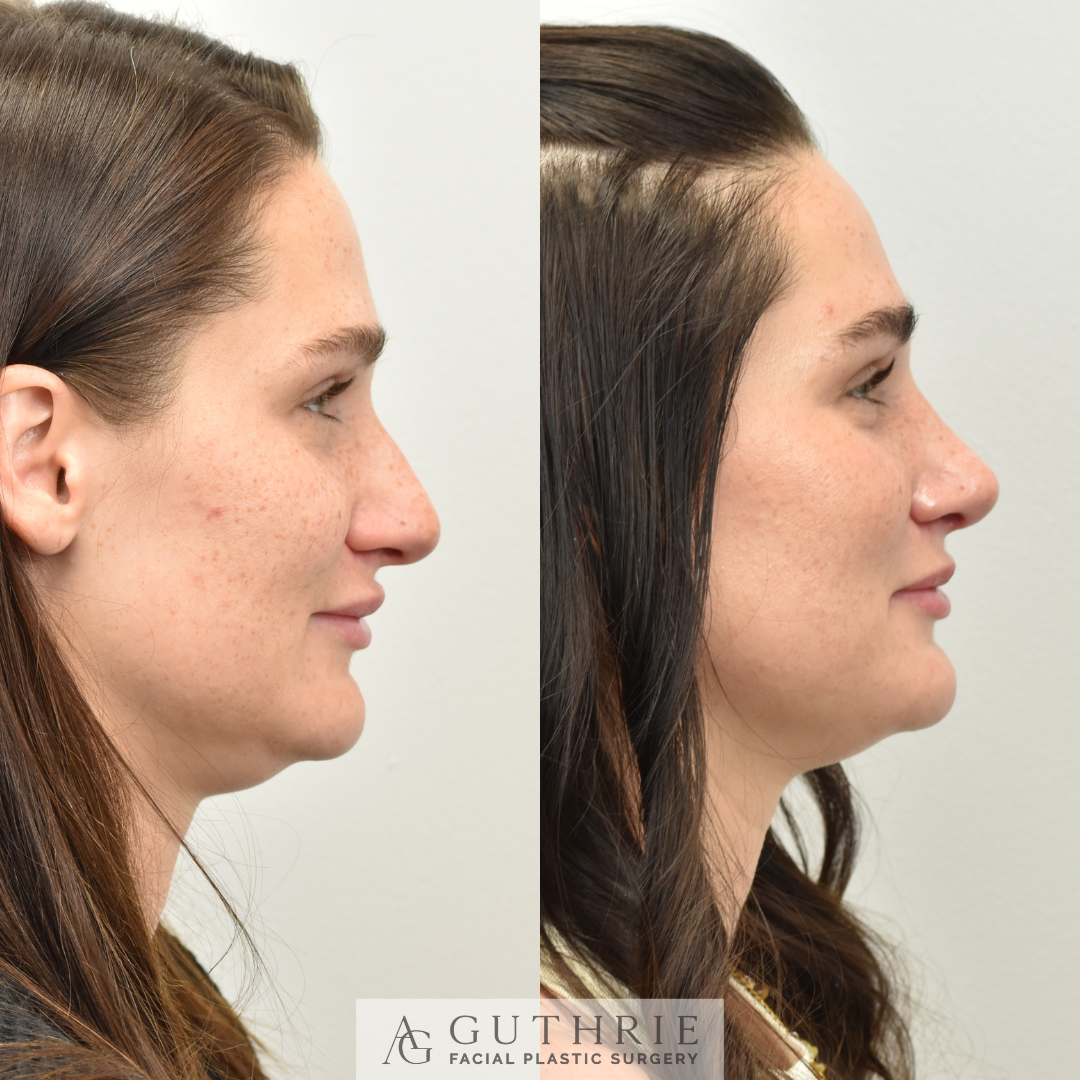 patient at guthrie facial plastic surgery before and after rhinoplasty surgery in brentwood nashville tennessee