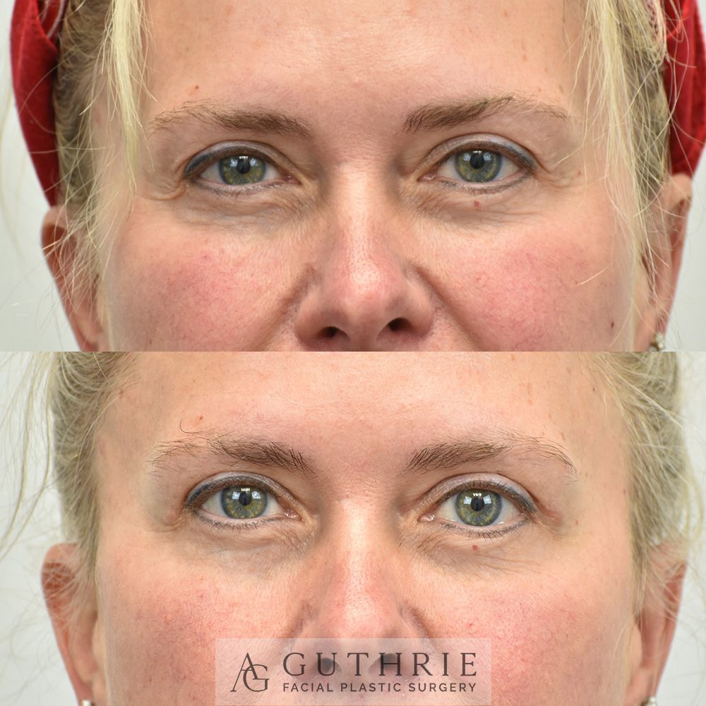 Before and 1 Month After Upper Blepharoplasty