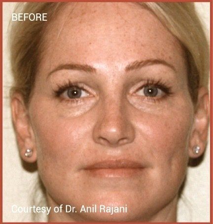 female patient before PRF treatment for brown spots