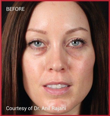 female patient before  PRF treatment for dark circles