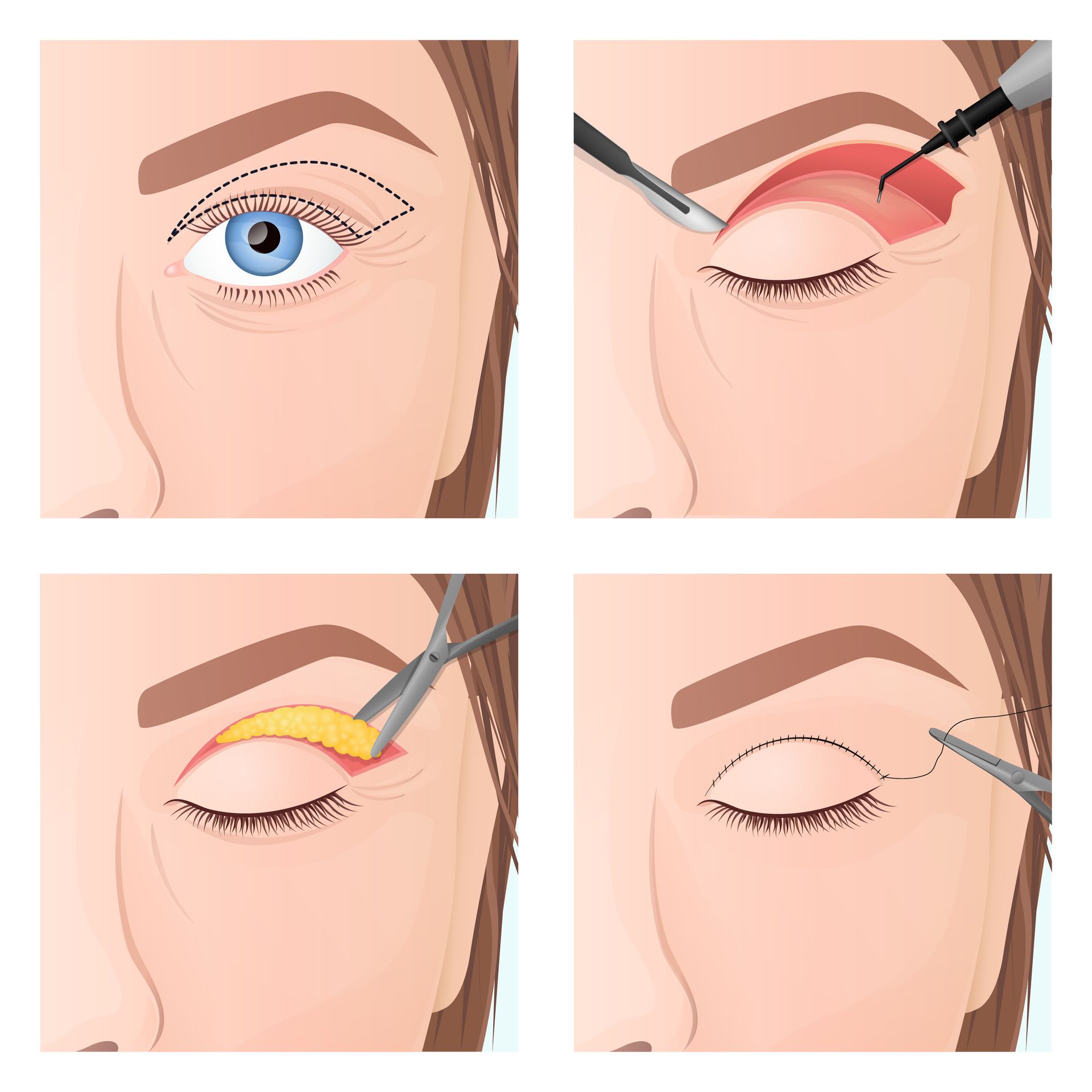 Brow lift surgery diagram showing brow and upper eyelid treatment areas