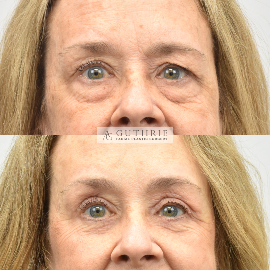 Before and After Upper and Lower Blepharoplasty