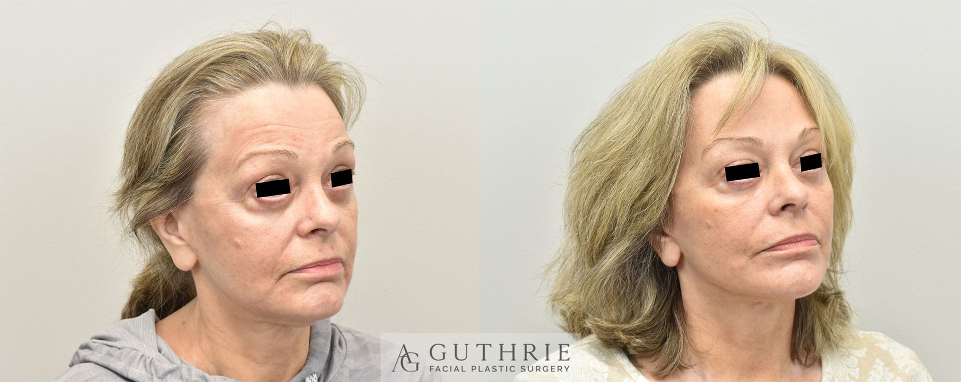 Before and After Facelift, Necklift, Upper and Lower Blepharoplasty, CO2 Laser