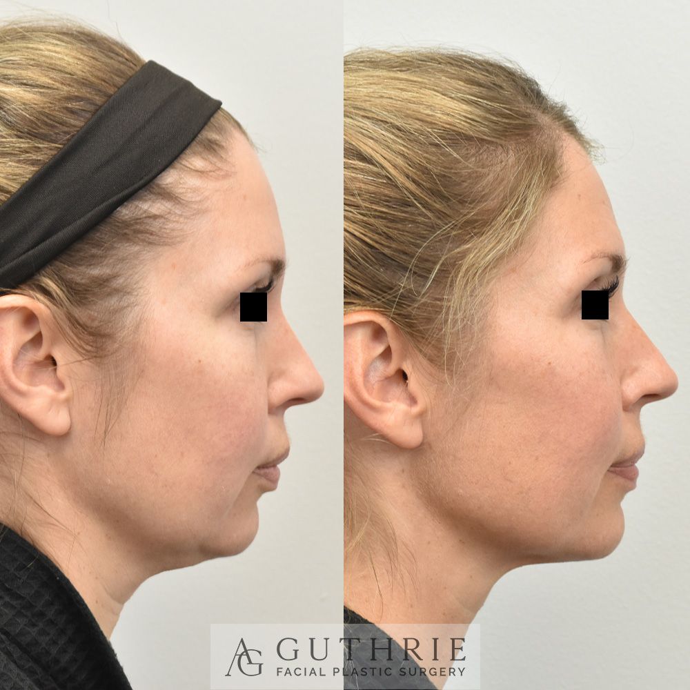 Before and After FaceTite Treatment, with Submental Liposuction