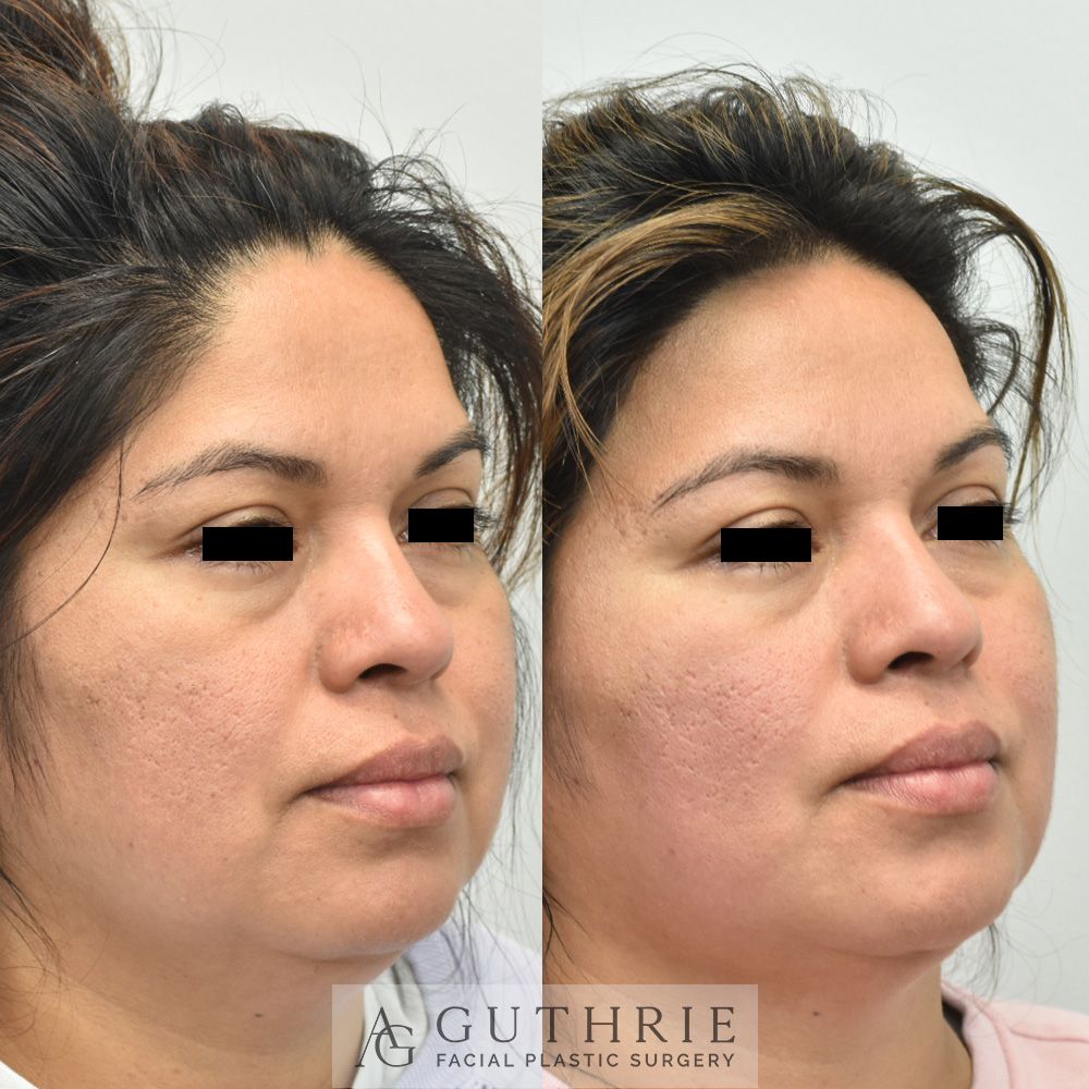 Before and After Submental Liposuction, Buccal Fat Reduction and Facetite