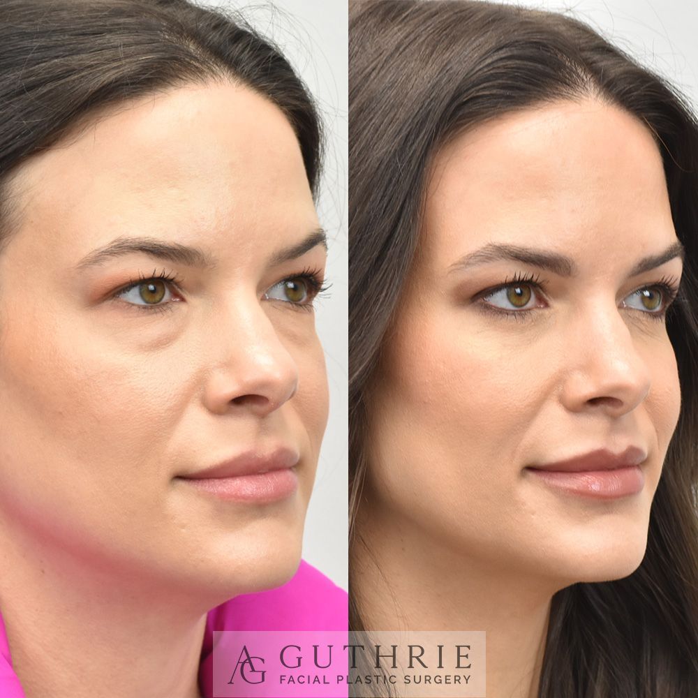 Before and After Lower Blepharoplasty