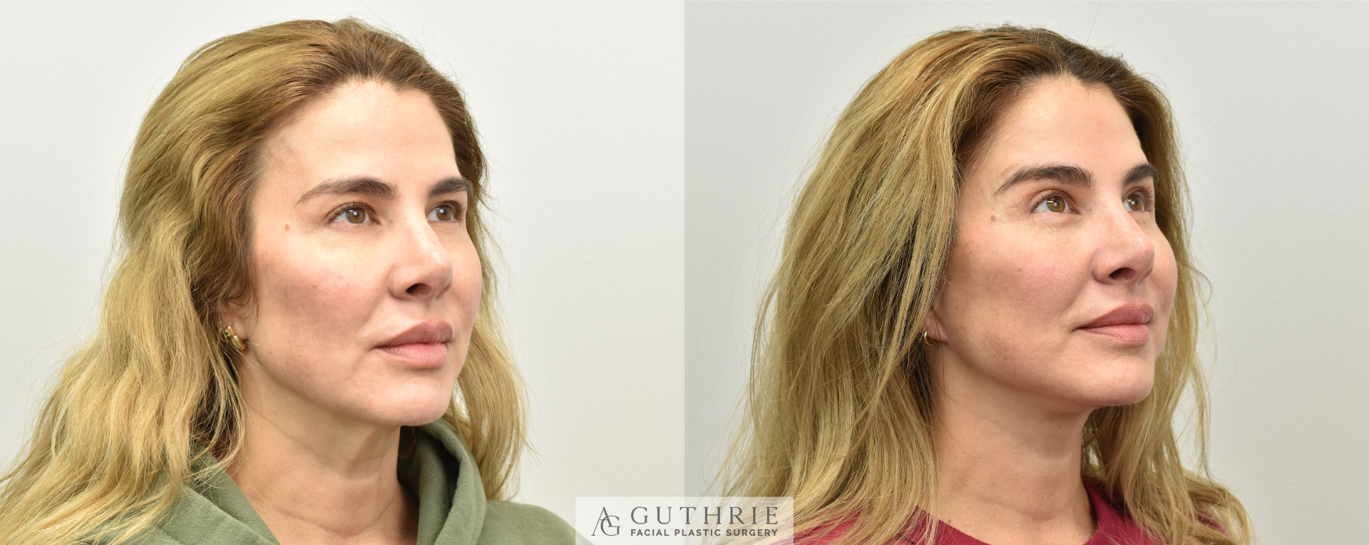 patient at Guthrie Facial Plastic Surgery in brentwood/nashville tn before and after facelift surgery