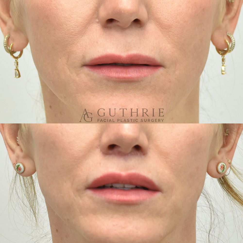 Before and After Subnasal Lip Lift