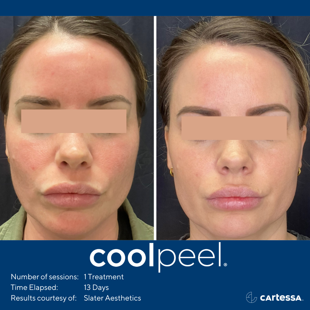 Before and After CoolPeel Laser Treatment