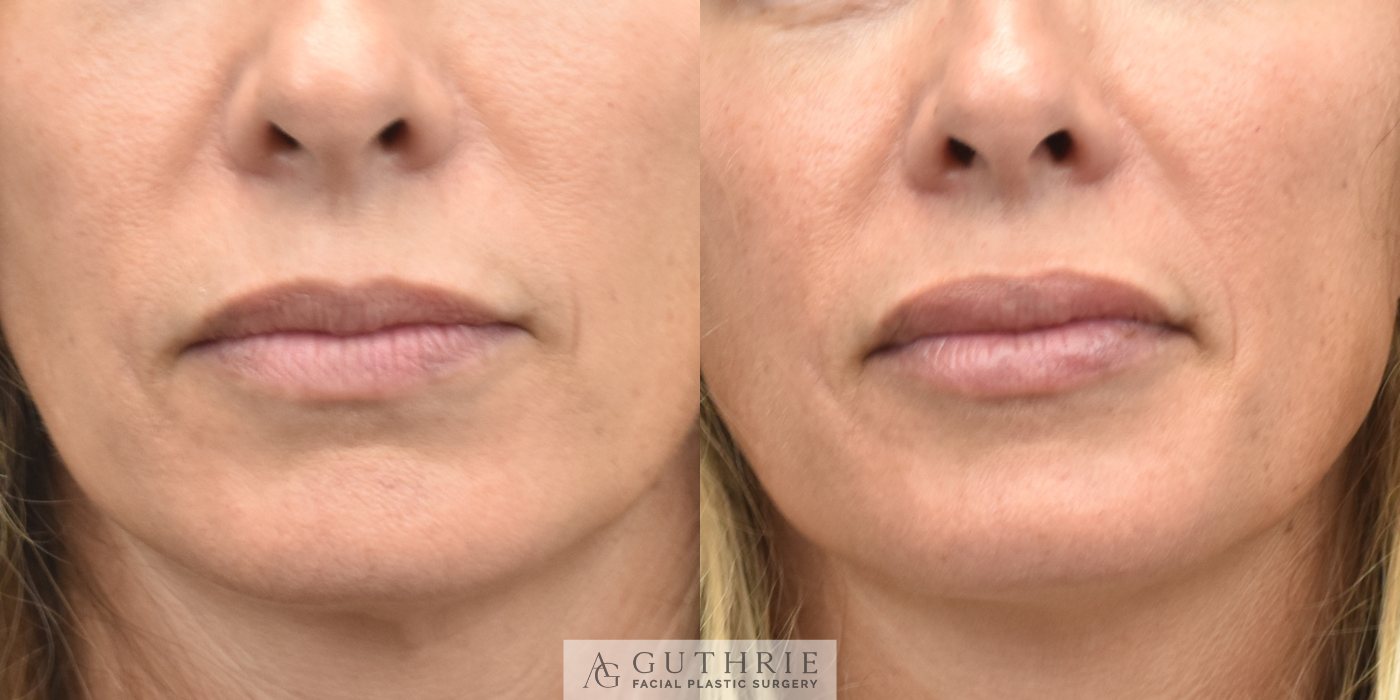 Before and After Lip Fillers