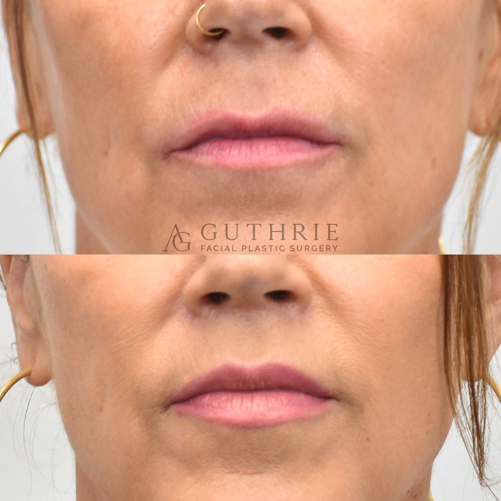 Before and 3 Months After Subnasal Lip Lift
