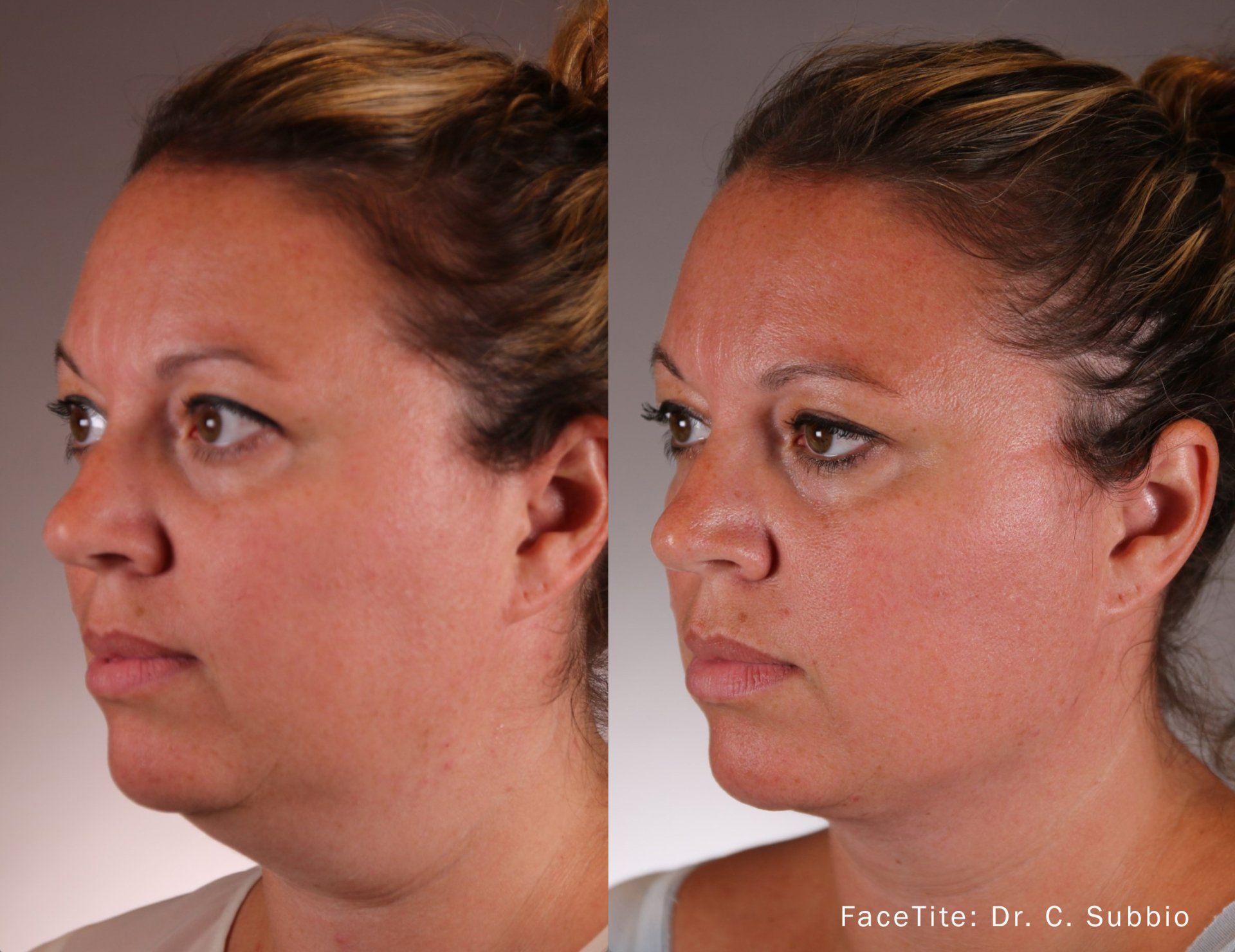 Before and After FaceTite Treatment