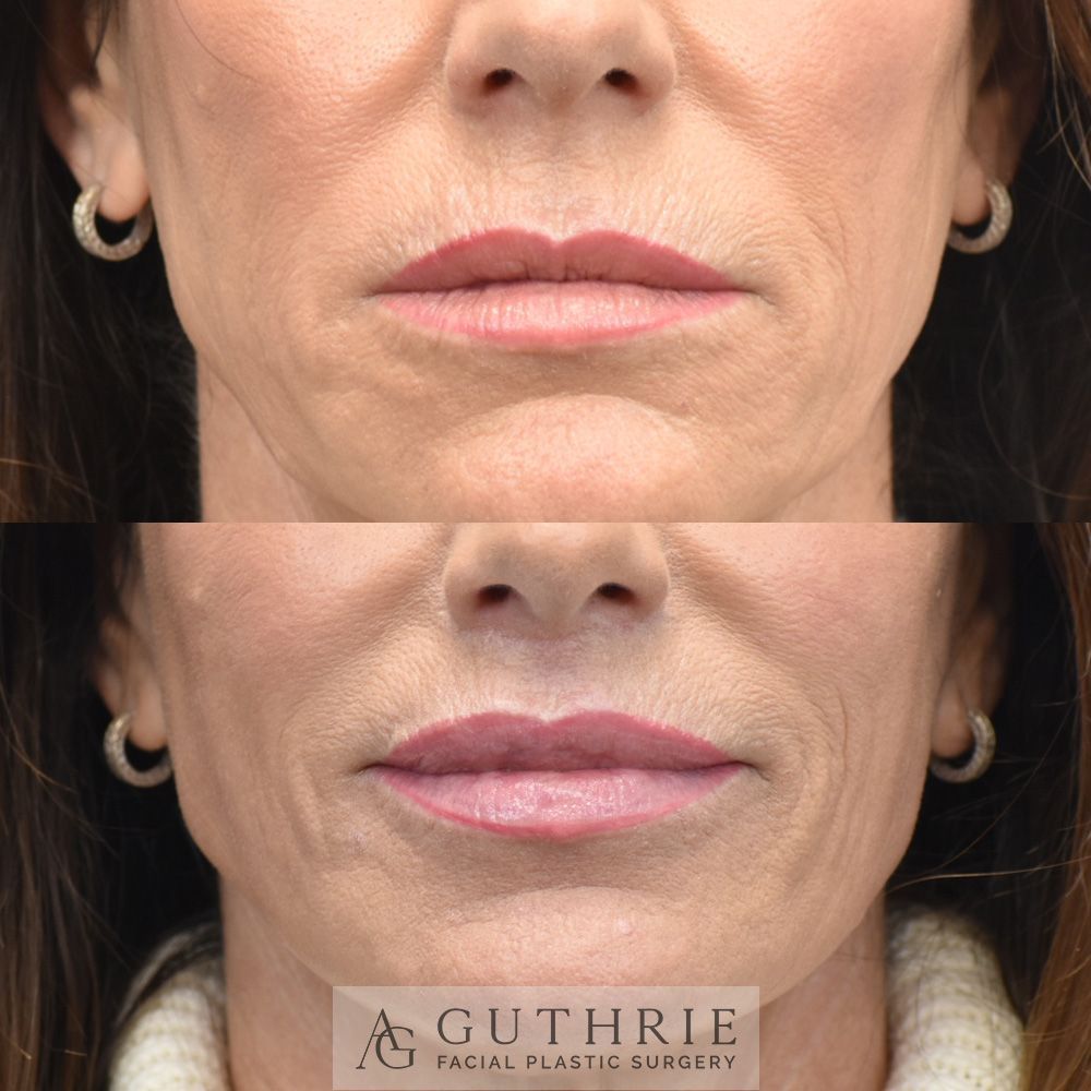 Before and After Subnasal Lip Lift
