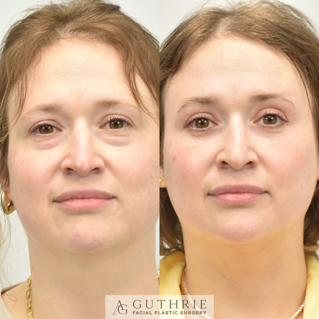 Before and After Lower Blepharoplasty with Fat Transfer
