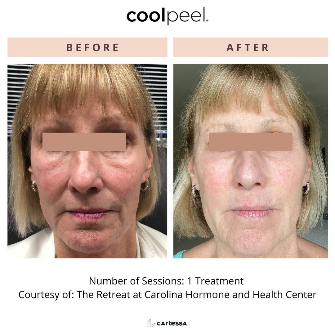 Before and After CoolPeel