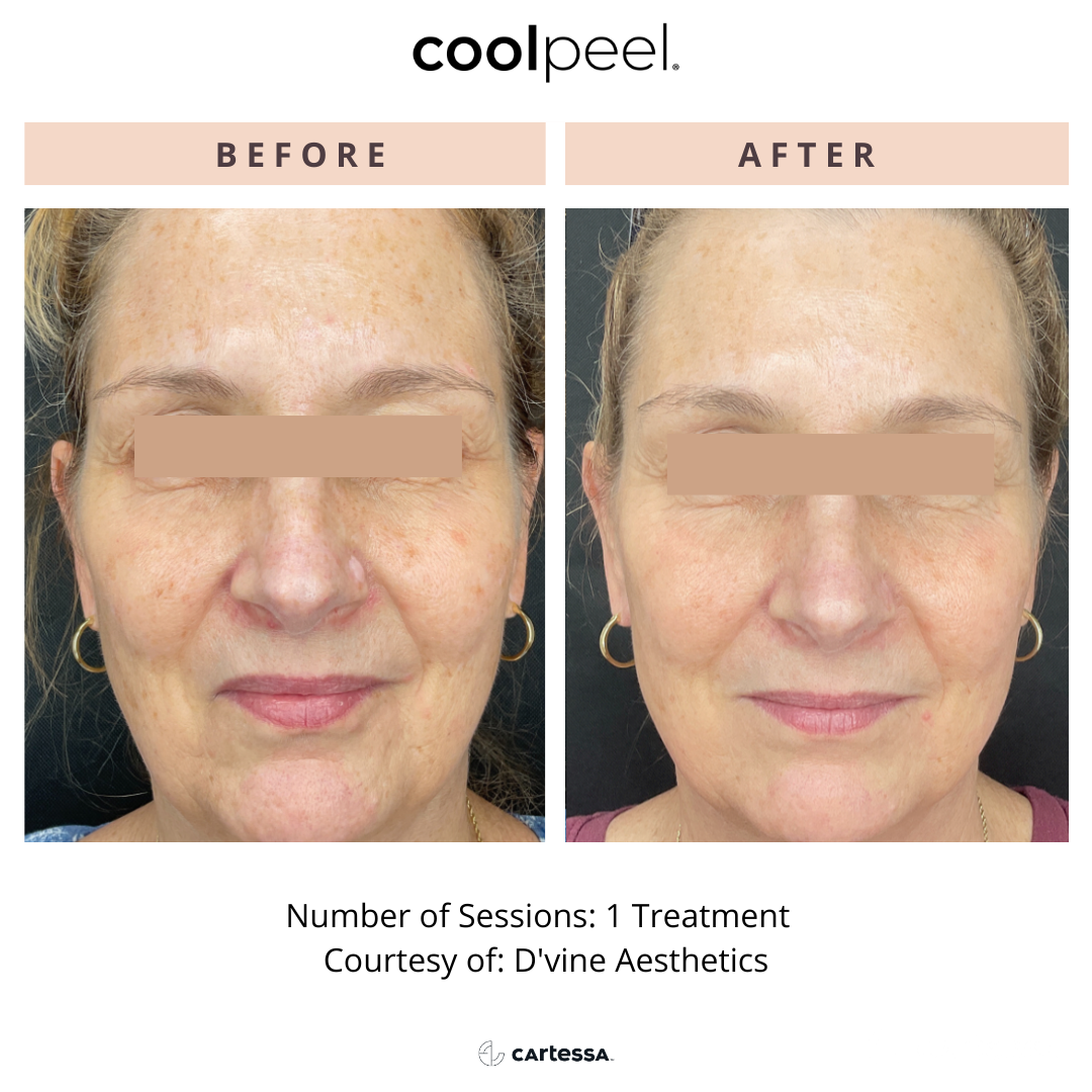 Before and After CoolPeel Laser Treatment