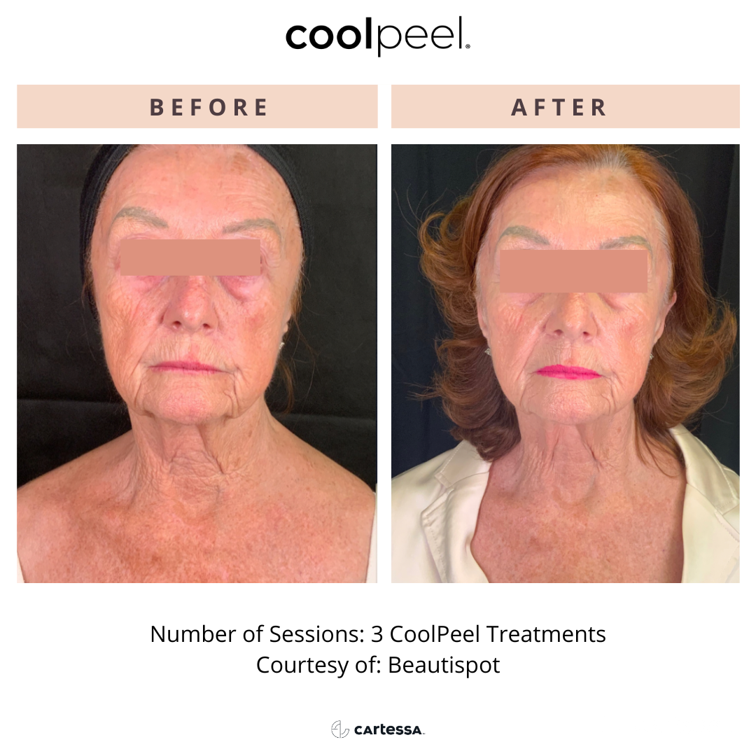 Before and After CoolPeel Laser Treatment