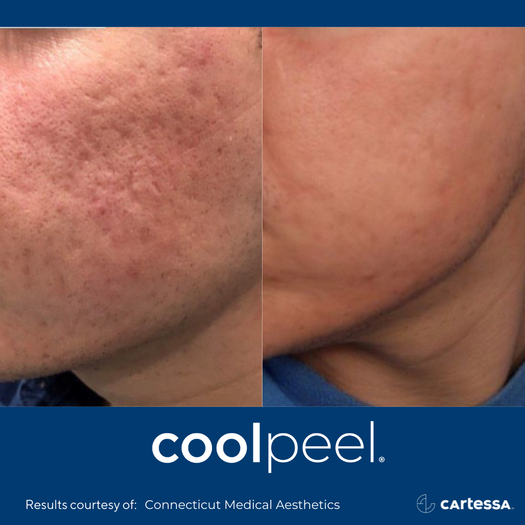 Before and After CoolPeel Laser Treatment