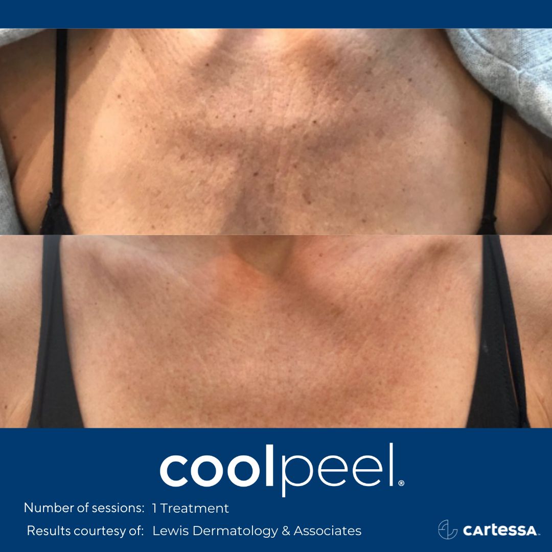 Before and After CoolPeel Laser Treatment