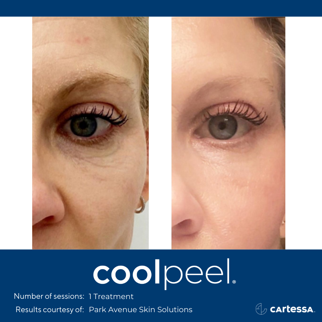 Before and After CoolPeel Laser Treatment