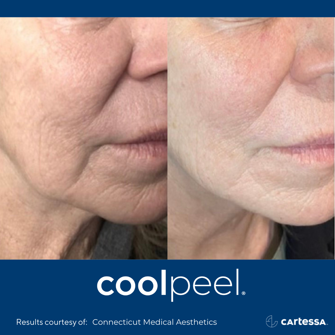 woman's face before and after CoolPeel treatment