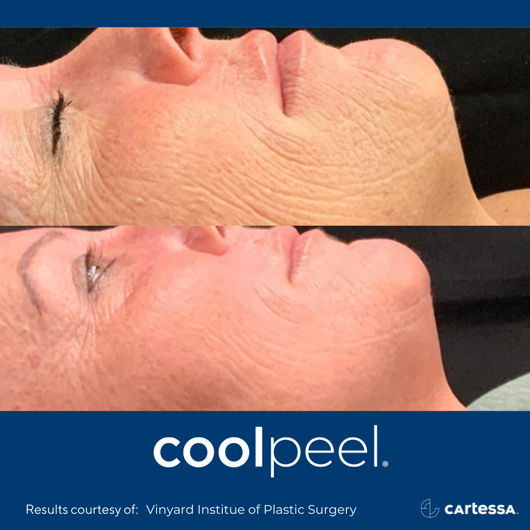 Before and After CoolPeel Laser Treatment