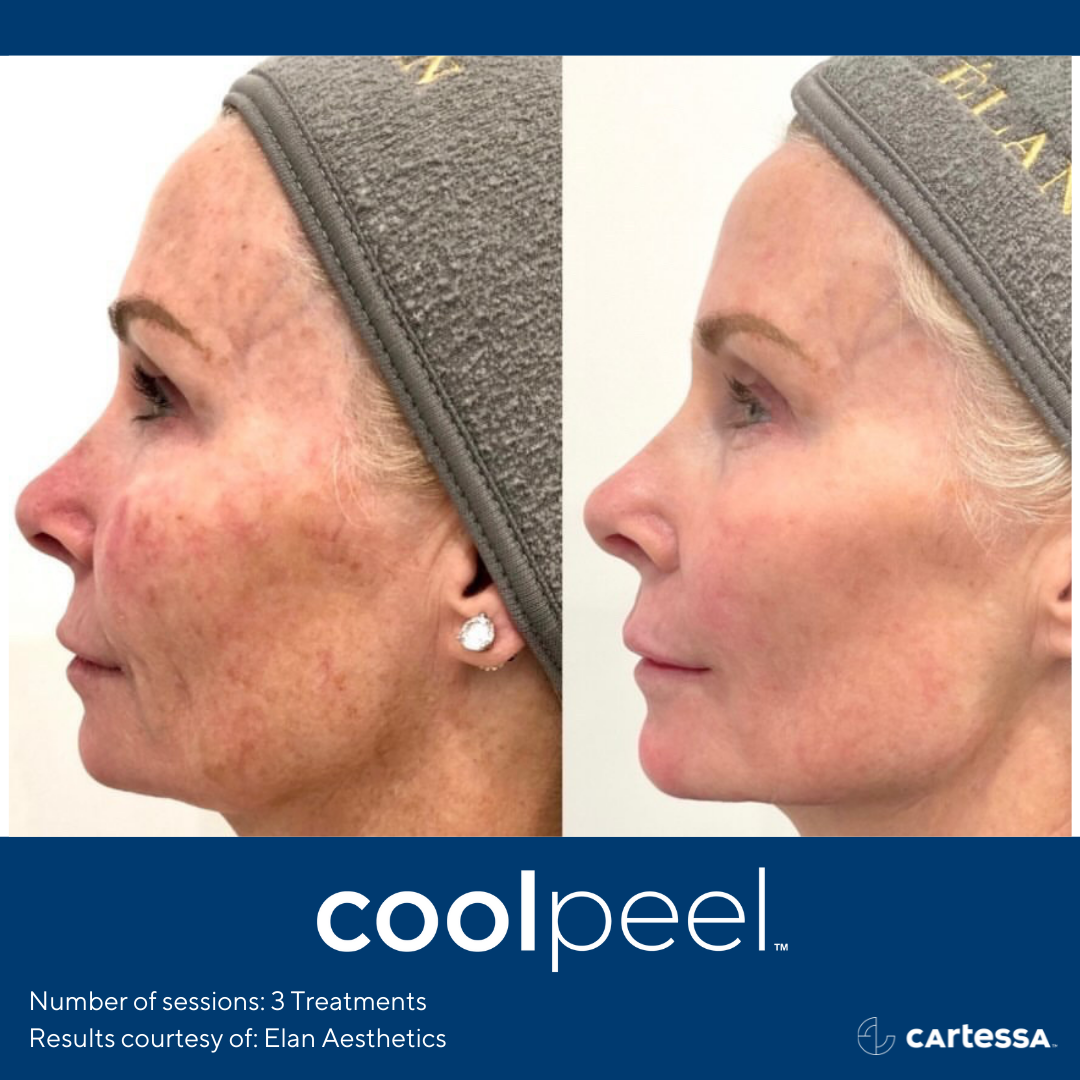 Before and After CoolPeel Laser Treatment