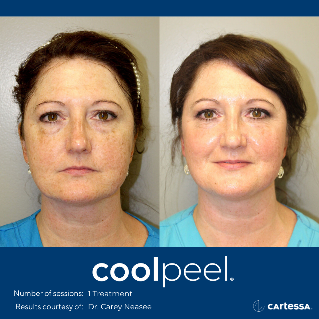 Before and After CoolPeel Laser Treatment
