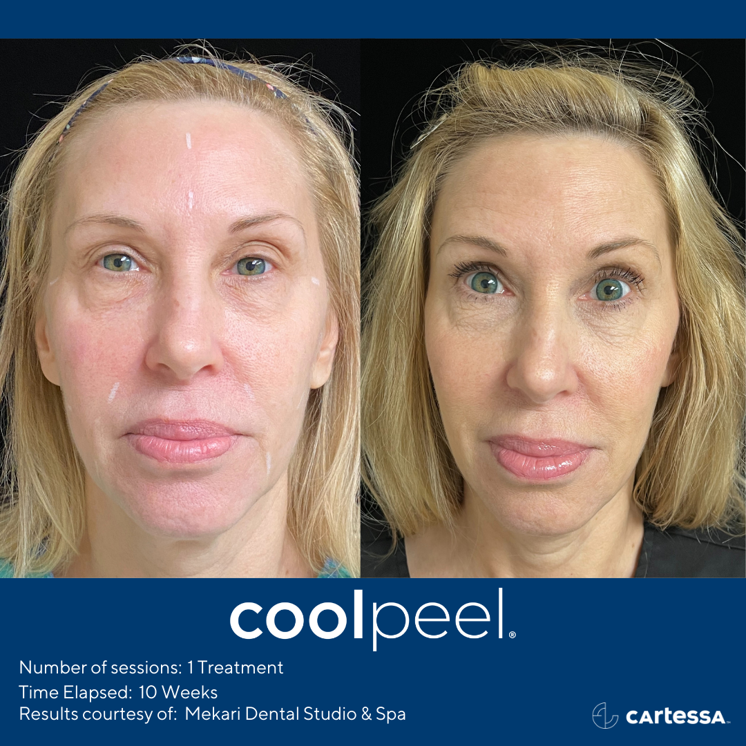 Before and After CoolPeel Laser Treatment