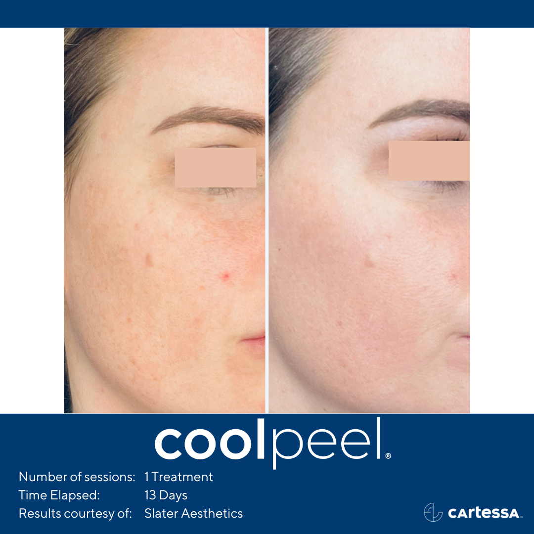 woman's face before and after CoolPeel treatment