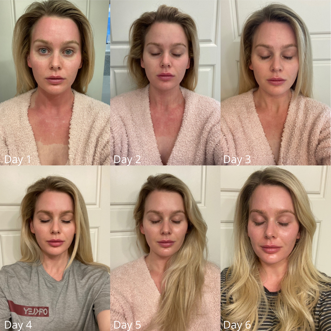 Before and After CoolPeel Laser Treatment