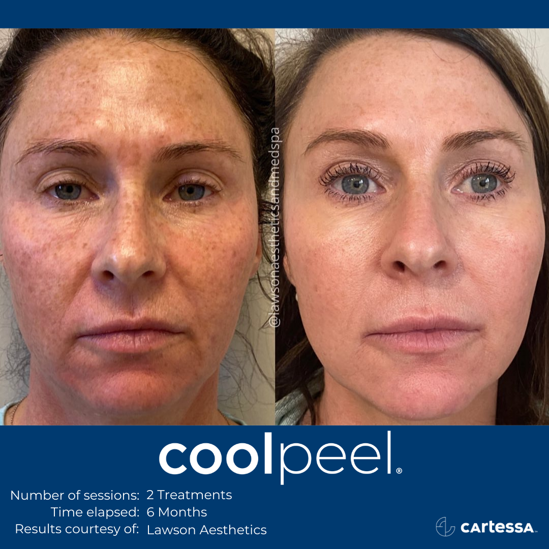 Before and After CoolPeel Laser Treatment