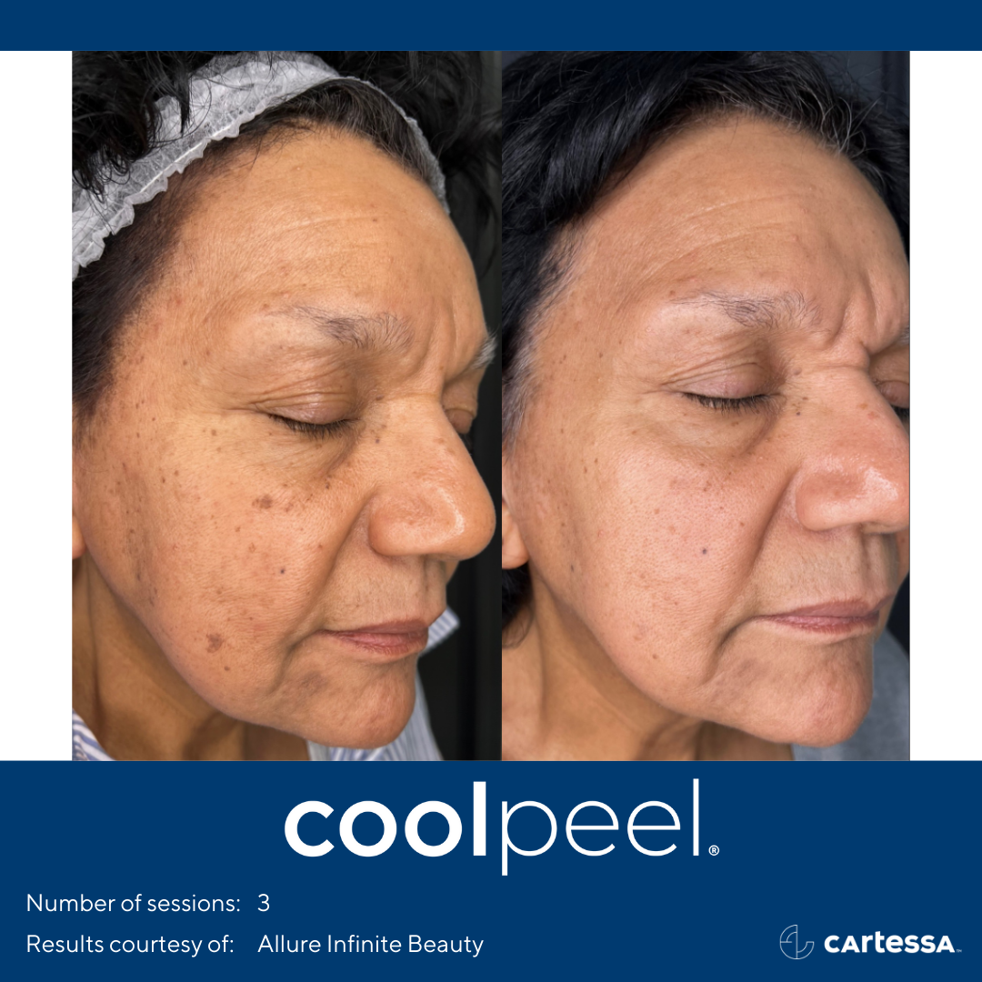 Before and After CoolPeel® Treatment
