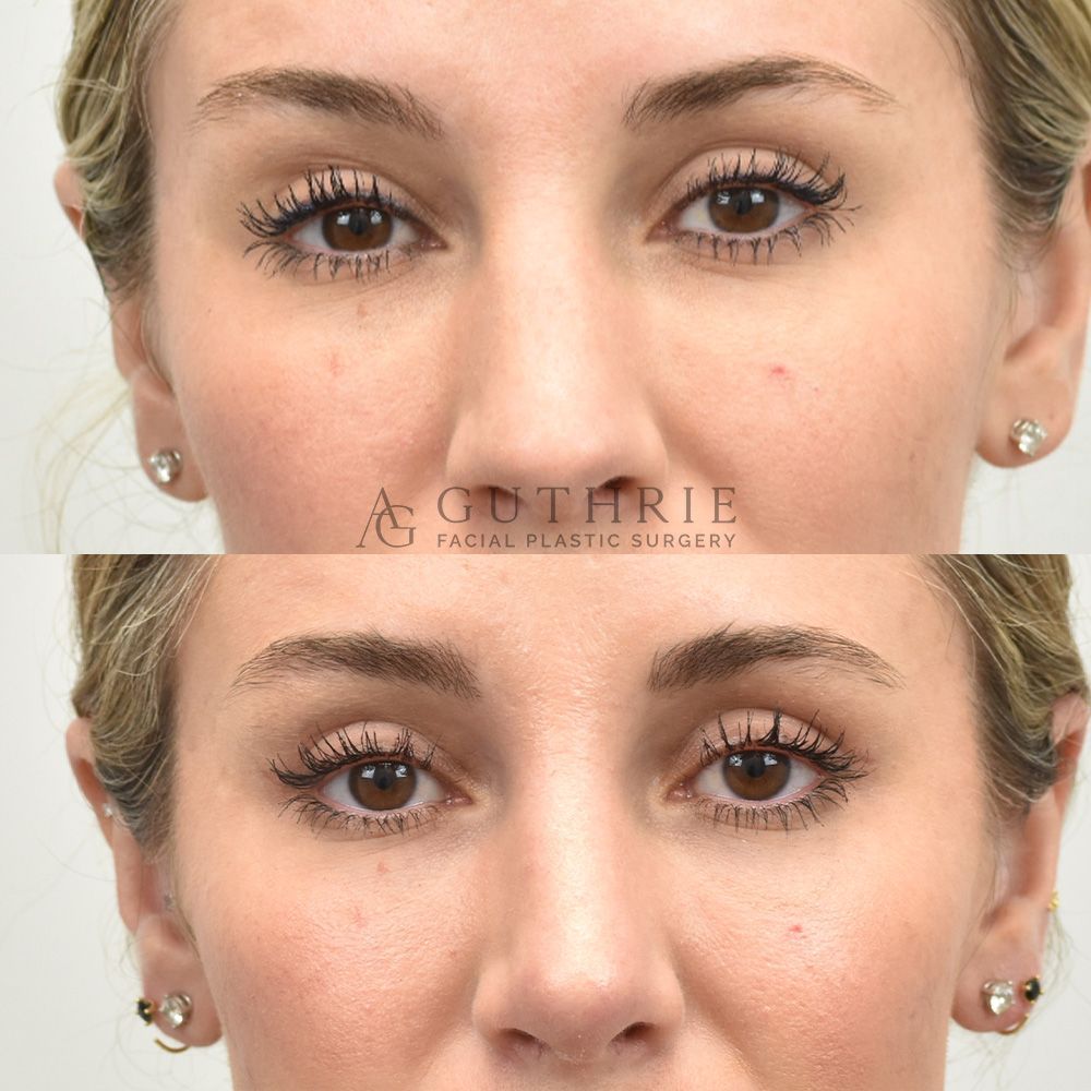 Before and 1 Month After Upper Blepharoplasty