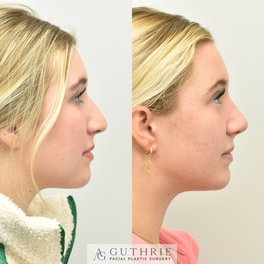 patient at guthrie facial plastic surgery before and after rhinoplasty surgery for nose