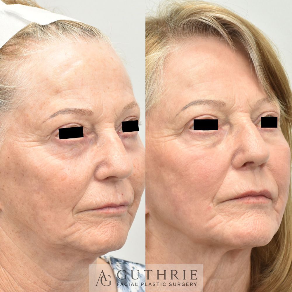 Before and After Tetra CO2 Laser Resurfacing Treatment