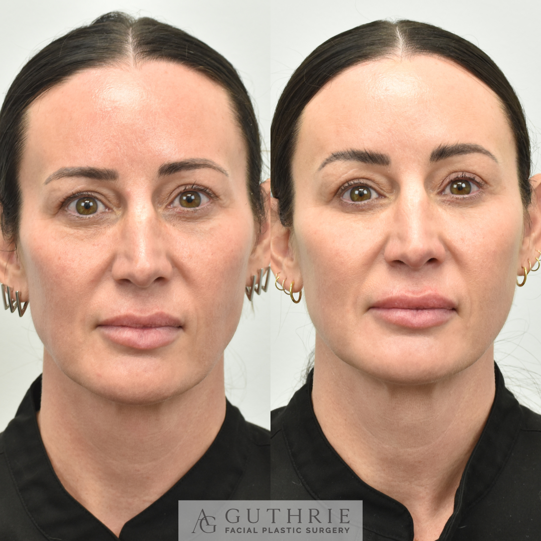 Before and After Lower Blepharoplasty