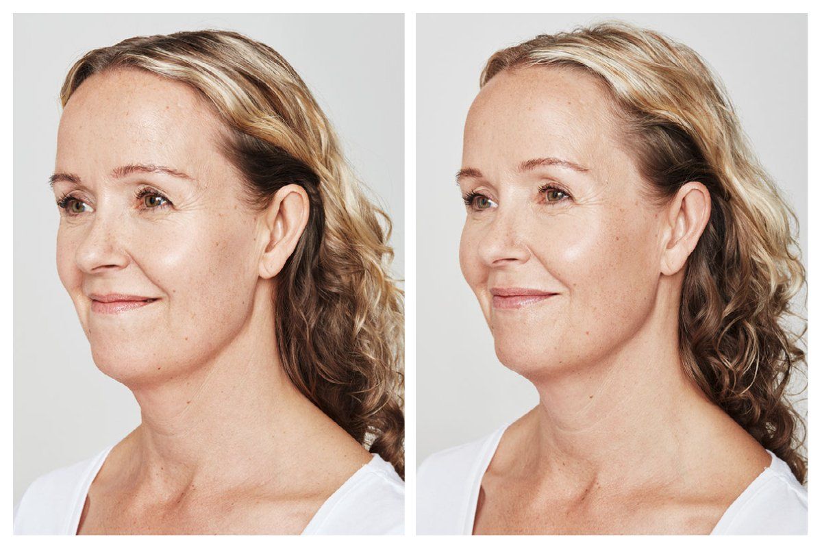 Neurotoxin - Dysport - Before and After